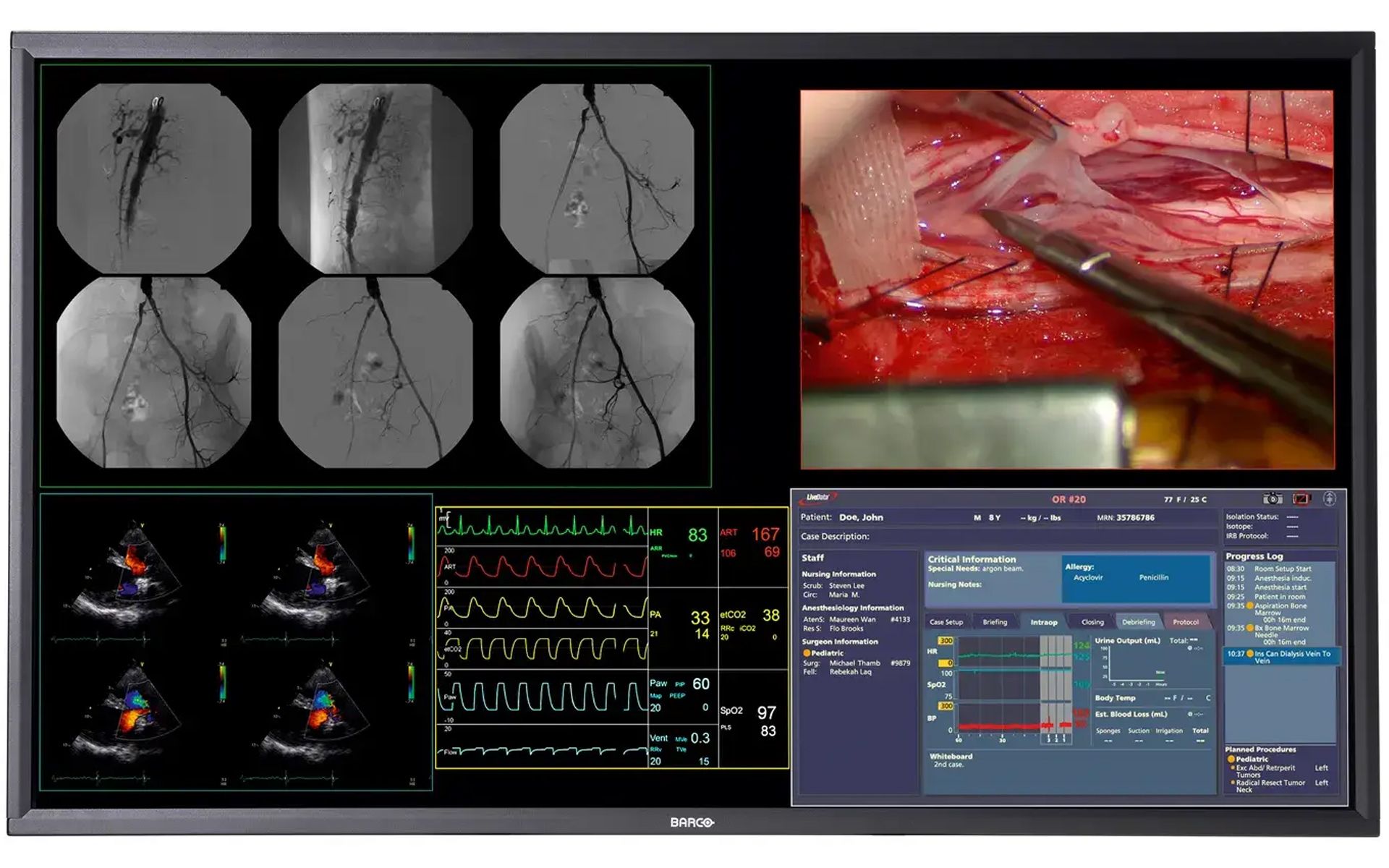 Barco MDSC-8358 58" 4K UHD Large Cath Lab Surgical Monitor