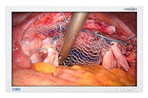 NDSsi Radiance 32" FHD G2 Surgical LCD Monitor 90R0076 w/o Single Fiber