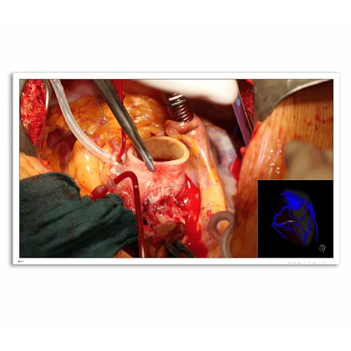 Eizo EX5841 58" 4K UHD Surgical Monitor