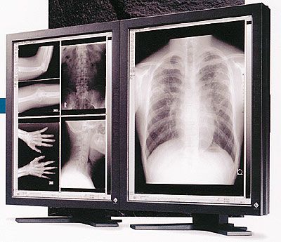 Eizo Radiforce FC-2091 3MP Diagnostic Display Monitor