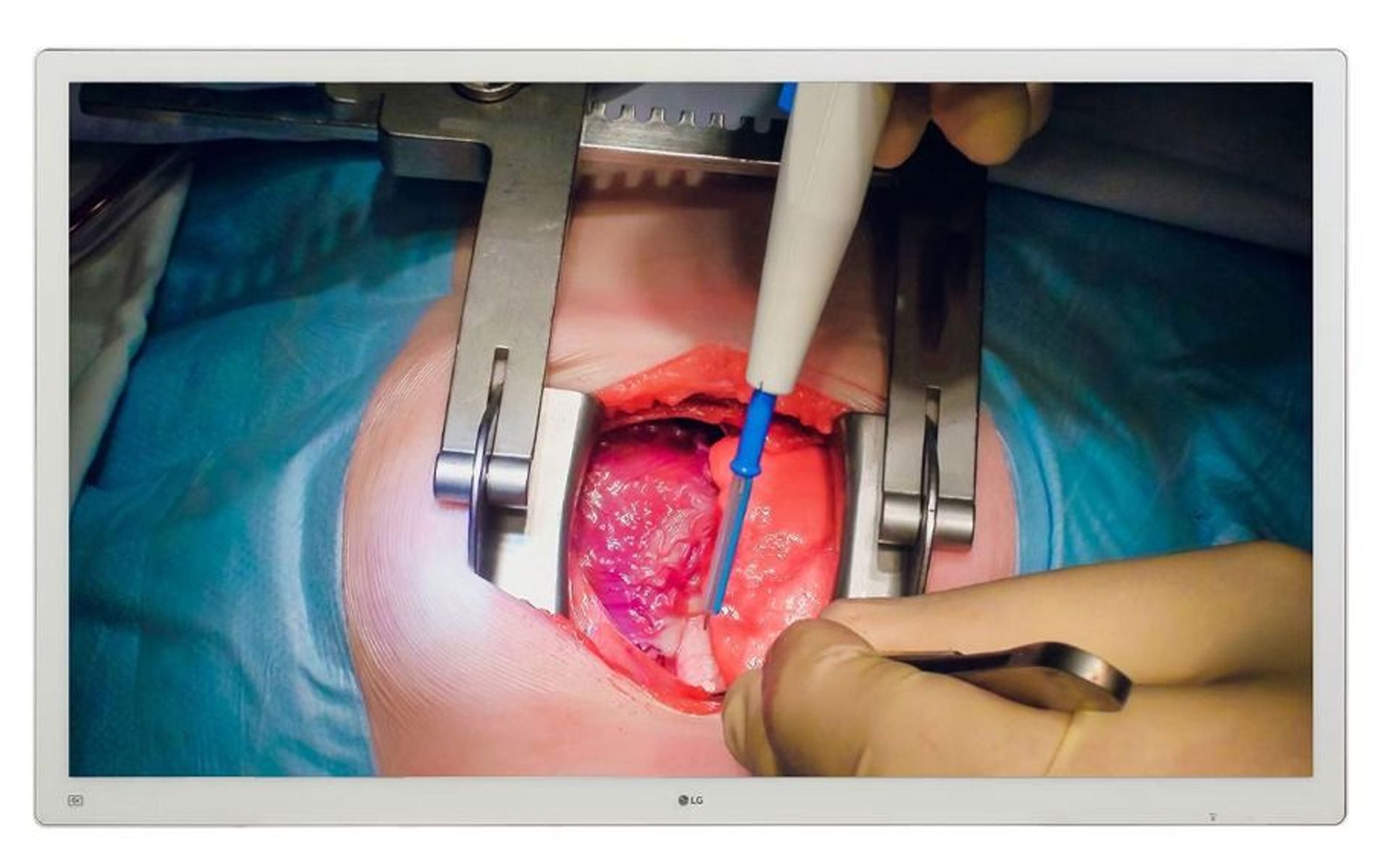 LG 55MH5K-W 55" 4K UHD IPS Surgical LCD Monitor